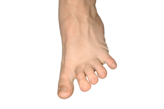 पैर की उंगली सड़ जाए तो क्या करें?